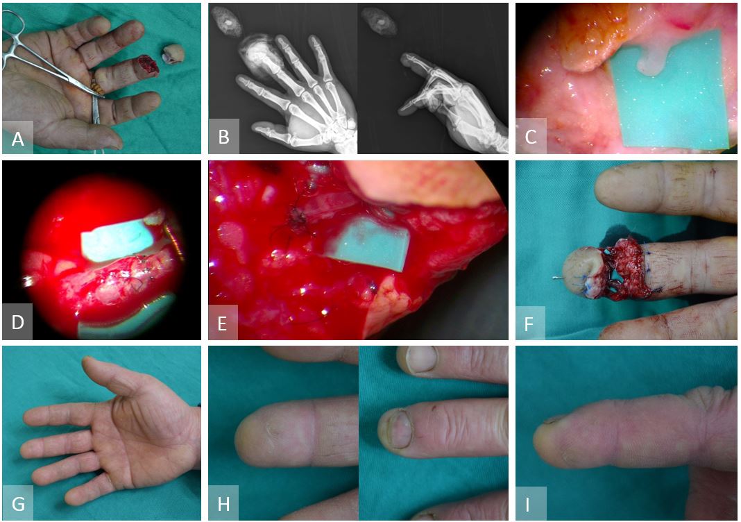 Fingertip (Tamai Zone I) Replantation under Local Anesthesia SciTeMed